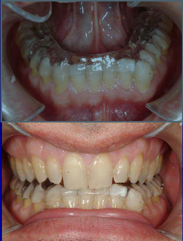 Stringi i denti! Quando lo stress notturno rovina il sorriso
