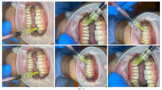 Parodontite e perimplantite: il ruolo dell’acido ialuronico reticolato e della laserterapia nel trattamento non chirurgico