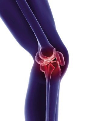 Artrosi del ginocchio: con la Tecarterapia® si riduce il dolore