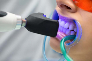 sbiancamento dentale