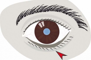 ectropion