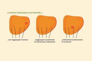 tumore prostata