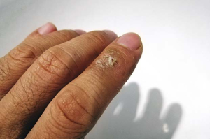 sclerodermia