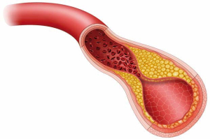 stenosi carotidea
