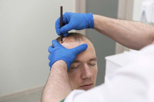 trapianto capelli