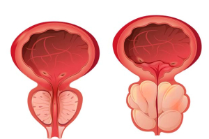 tumore prostata