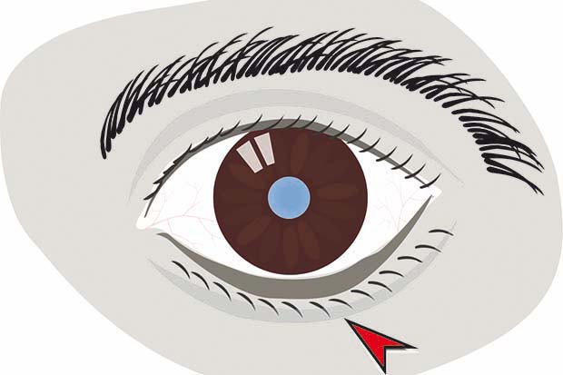 ectropion
