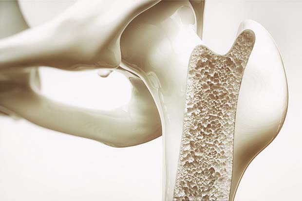 osteoporosi